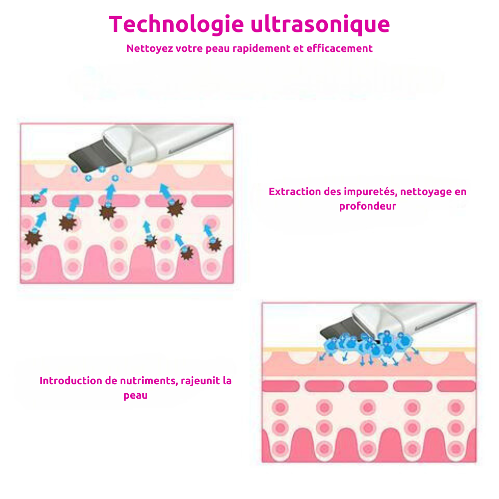 DermiCleanse - Appareil d’extraction des points noirs